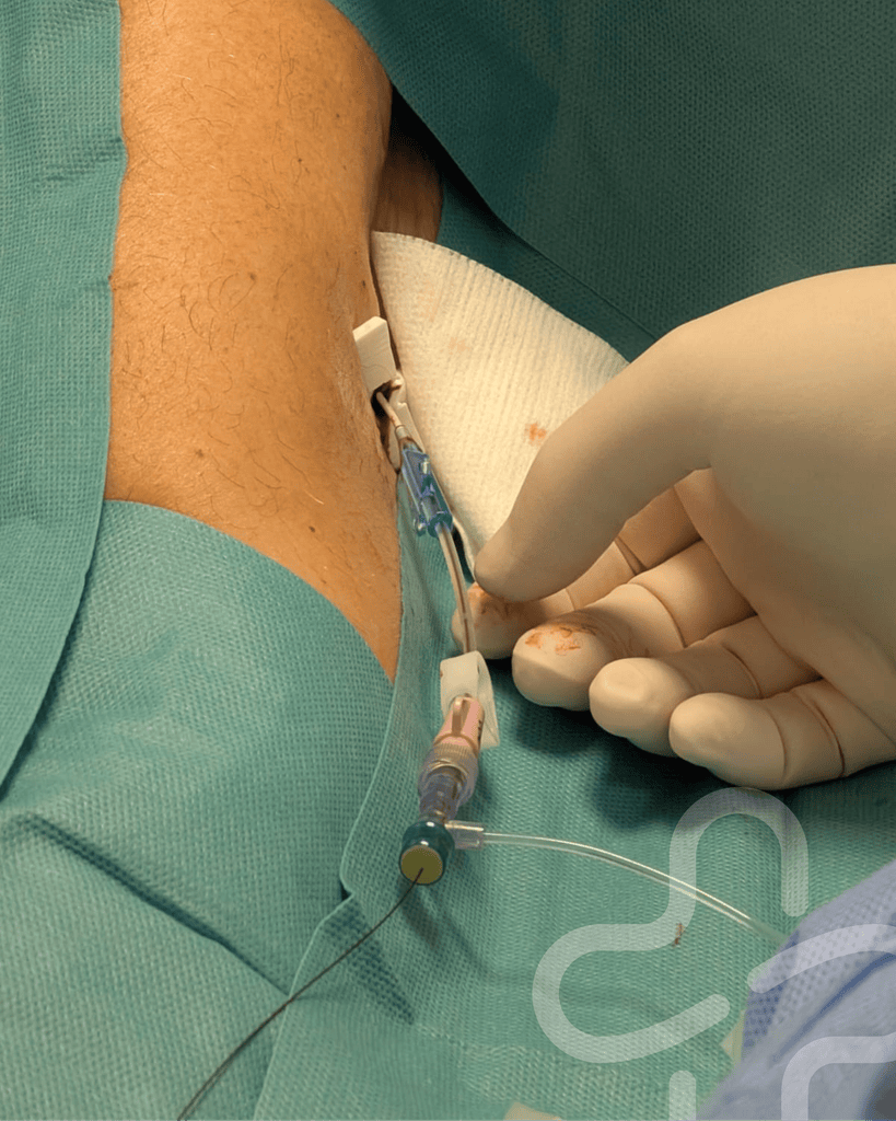 pcc line3 - Grande nouvelle à l’Hôpital Marie-Lannelongue : une première pour l’Unité d’Accès Vasculaire (UAV) !